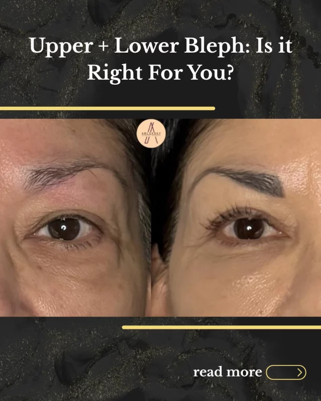 Eyelid surgery? ➡️ Let’s talk about it!
ㅤ
Comment “Natural” or call the office to book your consult with Dr. Ablavsky.
ㅤ
📍19296 Stone Oak Pkwy Ste 102
📞 (210) 942-6672
ㅤ
#EyelidSurgerySanAntonio #BlepharoplastySanAntonio #PlasticSurgery