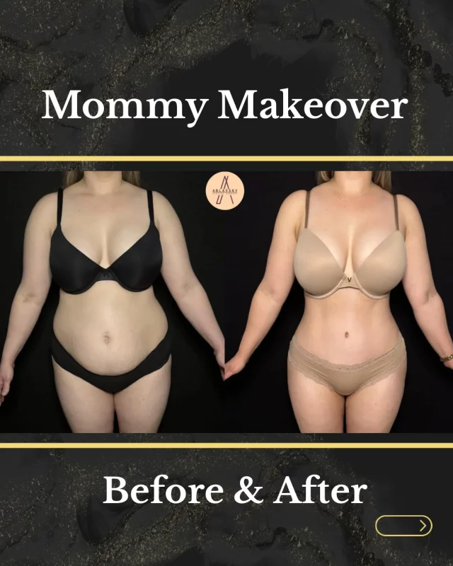 She said ⏳!
ㅤ
Ask us about our upcoming event!
🗓️ Friday, August 22 | 🕙 10 AM – 2 PM
ㅤ
Here’s what’s happening:
– Genius RF Microneedling (skin tightening + collagen boost)
– CO₂ Laser Resurfacing (texture, tone + glow)
– Free skin consultations
– One-day-only pricing
– Raffle + skincare giveaways
– Light bites + more!
ㅤ
📞 RSVP required — call (210) 942-6672 to reserve your spot!
ㅤ
ㅤ
📍 19296 Stone Oak Pkwy STE 102 San Antonio, Texas 78258
📱 (210) 942-6672
ㅤ
#PlasticSurgerySanAntonio #MommyMakeover #HourGlassBody
ㅤ