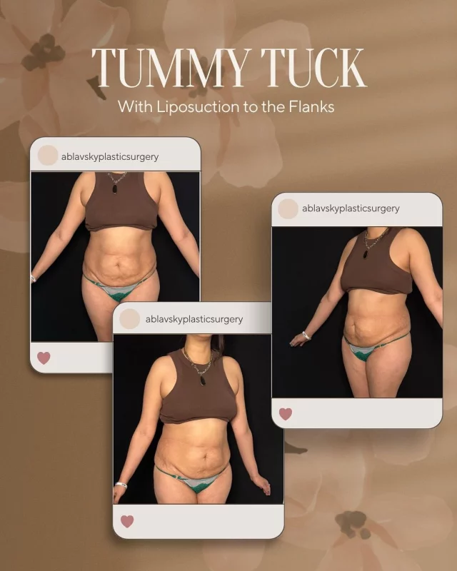 ✨ Transformation Tuesday ✨
Swipe to see this incredible tummy tuck journey! ➡️

From loose skin and weakened muscles to a smooth, toned, and confident silhouette — this transformation is all about restoring not just the body, but confidence too. 💃✨

Tummy tucks aren’t just cosmetic — they repair core strength, improve posture, and help clothes fit comfortably again. Most importantly, they help you FEEL like you again. 💖

📍 Customized surgical plan
🗓️ 3 month post-op
💪 Muscle repair + skin tightening

Ready to start your transformation?
📲 DM us or click the link in bio to schedule your consultation!

📍19296 Stone Oak Pkwy Suite 102, San Antonio, TX 78258

#TummyTuck #Abdominoplasty #BeforeAndAfter #MommyMakeover #ConfidenceRestored #PlasticSurgeryJourney #RealResults #BodyContour #PostOpProgress