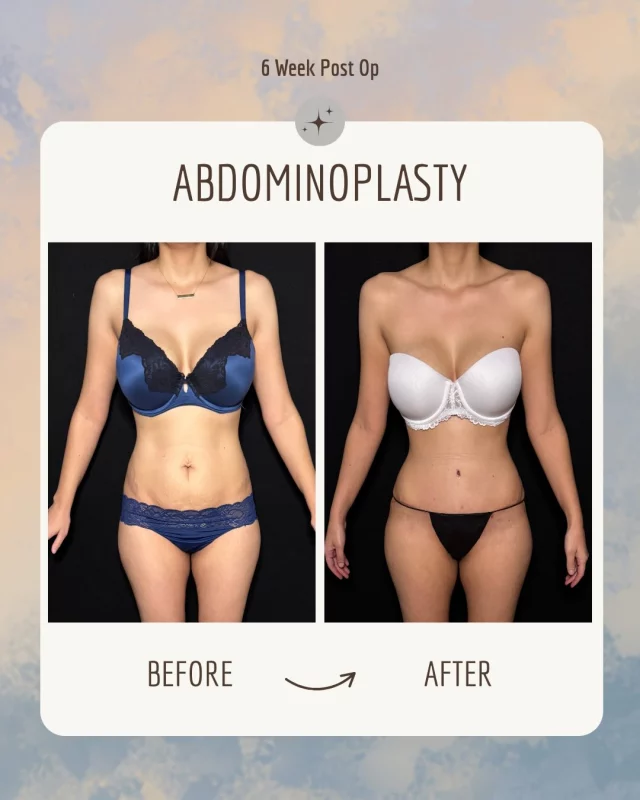 ✨ Transformation Tuesday ✨
A smoother, flatter, more refined waistline with a scar designed to stay low and discreet. This patient wanted natural contouring with minimal incision visibility — and the results speak for themselves.

🔹 Shorter incision
🔹 Tightened abdominal muscles
🔹 Improved lower-abdominal contour

Every body is unique, and your treatment plan should be too.
Book your consultation to explore what’s possible for you. 💛

📍19296 Stone Oak Pkwy Suite 102, San Antonio, TX 78258

#TummyTuck #ShortScarTummyTuck #BeforeAndAfter #BodyContour #MommyMakeover #PlasticSurgery #ConfidenceJourney #AblavskyPlasticSurgery