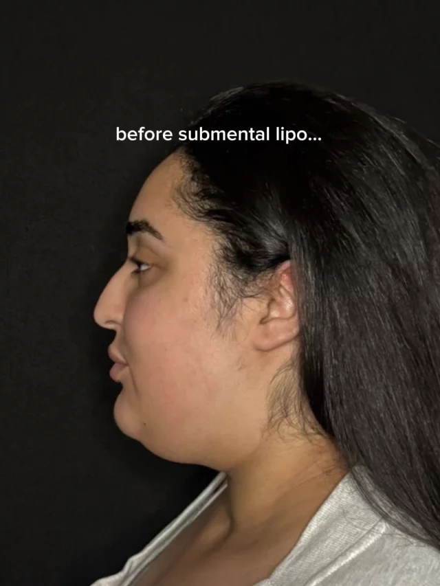 Here’s what submental lipo actually does:
ㅤ
• Snatches the under-chin area
• Defines your jawline (hello profile pics)
• Smooths that jaw-to-neck transition
• Makes everything look a little more “put together”
• And yes… it works even if you’ve “tried everything”
ㅤ
It’s a quick, confidence-boosting procedure for anyone who wants a cleaner, more defined look without going full facelift.
ㅤ
Curious if you’d be a good fit? Drop a question below or give us a call 💬🤍
ㅤ
Address: 19296 Stone Oak Pkwy Ste 102, San Antonio, Texas 78258
Phone: (210) 942-6672
ㅤ
#SubmentalLipo #ChinLipo #SanAntonio