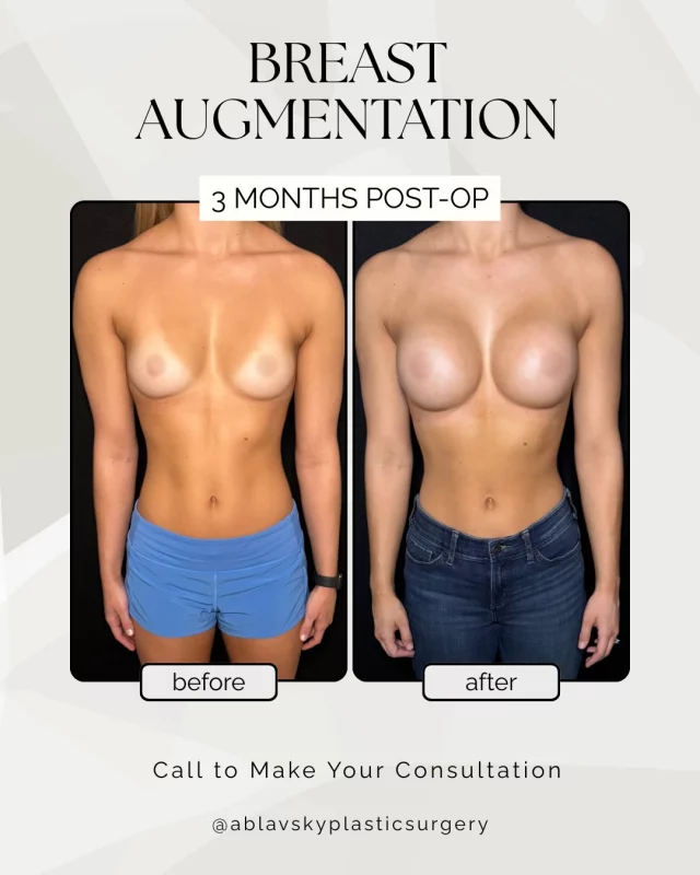 ✨ Transformation Tuesday✨
Subtle shape, balanced proportions, and a result tailored to her goals.
Every body is unique—and so is every surgical plan. Customized care. Thoughtful planning. Beautiful results.

📩 DM us to schedule your consultation
📍19296 Stone Oak Pkwy Suite 102, San Antonio, TX 78258

#BreastAugmentation #BeforeAndAfter #PlasticSurgeryJourney #PostOpProgress