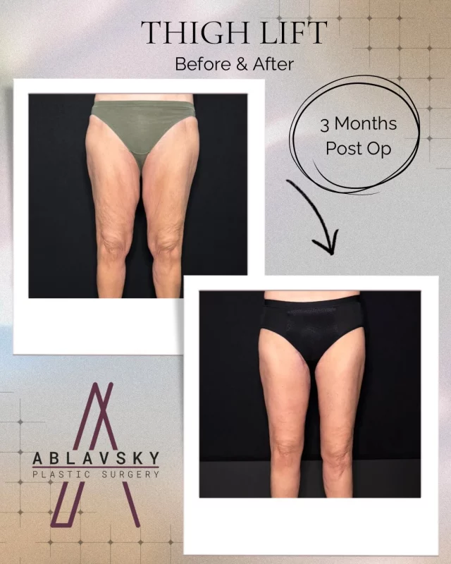 ✨ Transformation Tuesday✨
From excess skin to smooth, contoured thighs — this before & after showcases the transformative results of a thigh lift. Designed to improve comfort, contour, and confidence for patients after weight loss or skin laxity.

Results are individualized, but the goal is always the same: natural-looking contours and renewed confidence. 💫

📩 DM us to schedule your consultation
📍19296 Stone Oak Pkwy Suite 102, San Antonio, TX 78258

#ThighLift #Abdominoplasty #BeforeAndAfter #MommyMakeover #ConfidenceRestore #TummyTuck #PostWeightLoss #SkinTightening#BreastLiftTransformation #PlasticSurgeryJourney #RealResults #BodyContour #PostOpProgress