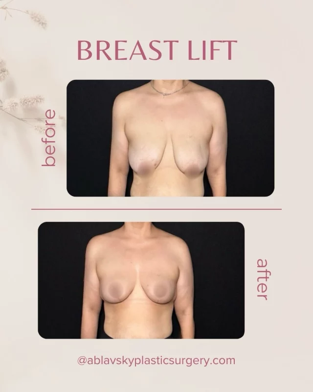 ✨ Transformation Tuesday✨

This before & after showcases the power of a breast lift—restoring a more youthful, elevated shape while maintaining natural-looking results.
Perfect for patients experiencing sagging due to weight changes, pregnancy, or aging.

📩 DM us to schedule your consultation
📍19296 Stone Oak Pkwy Suite 102, San Antonio, TX 78258

#Mastopexy #BeforeAndAfter #PlasticSurgeryJourney #PostOpProgress