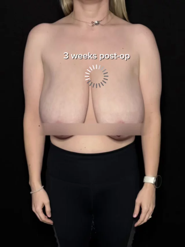 Don’t forget to book 🤍
ㅤ
Three weeks post–breast reduction: edema is improving, tissue is stabilizing, and scar therapy has begun to optimize incision healing and long-term scar quality.
ㅤ
19296 Stone Oak Pkwy Ste 102, San Antonio, Texas 78258
(210) 942-6672
ㅤ
#BreastReduction #PlasticSurgeonSanAntonio #Mommymakeover
