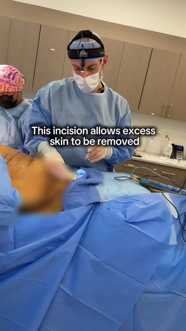 Incision placement and cautery technique are critical components of a successful tummy tuck. Your surgeon strategically plans incisions in areas that can be easily concealed, while cautery technology seals blood vessels in real-time, reducing bleeding and supporting optimal healing. This combination of skill and technology means less bruising, lower complication risks, and beautiful, lasting results. Knowledge is power when it comes to your body transformation.
ㅤ
See our website in bio for B&As!
ㅤ
📍 19296 Stone Oak Pkwy Ste 102 San Antonio, Texas 78258
☎️ (210) 942-6672
ㅤ
#TummyTuck #Abdominoplasty #PlasticSurgeryEducation​​​​​​​​​​​​​​​​
ㅤ