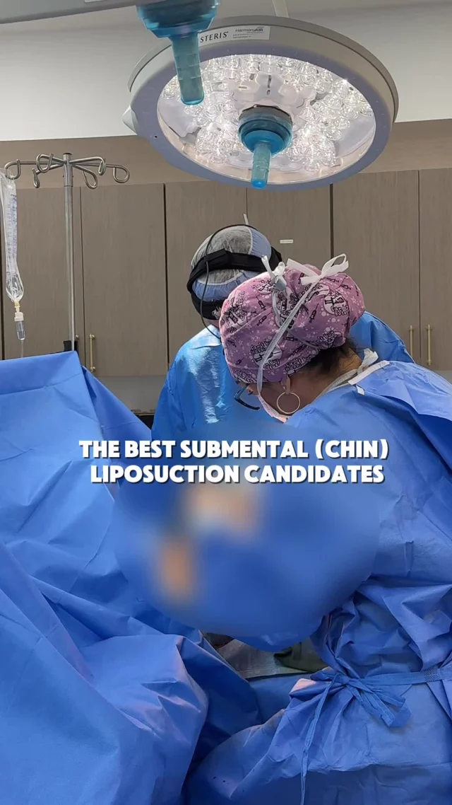 Who are the best candidates for submental liposuction?
ㅤ
Dr. A often sees the best results in younger patients with fuller necks and a higher BMI who:
ㅤ
• Have good skin elasticity
• Carry fullness under the chin that doesn’t respond to diet or exercise
• Want a more defined jawline without major surgery
• Do not have significant skin laxity
ㅤ
Submental liposuction is designed to remove excess fat under the chin. It doesn’t not tighten loose skin. That’s why age and skin quality matter.
ㅤ
If you’re noticing a persistent “double chin” despite being otherwise healthy, this procedure may be a strong option.
ㅤ
The best way to know? A consultation with a board-certified plastic surgeon who can evaluate your anatomy and goals.
ㅤ
📍 19296 Stone Oak Pkwy Ste 102, San Antonio, Texas 78258
📞 (210) 942-6672
ㅤ
Schedule your consultation today.