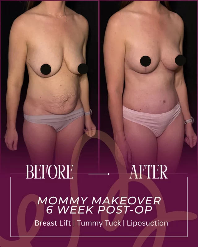 ✨ Mommy Makeover Transformation ✨

Motherhood is beautiful… but it can change the body in ways diet and exercise can’t always correct. This stunning transformation includes a breast lift, tummy tuck, and liposuction to the flanks to restore shape, contour the waist, and rejuvenate the silhouette.

Every result is personalized to the patient’s goals, anatomy, and lifestyle.

Ready to feel like the best version of yourself again? Schedule your consultation today.

📍19296 Stone Oak Pkwy Suite 102, San Antonio, TX 78258

#MommyMakeover #BreastLift #TummyTuck #Liposuction #SurgicalTransformation