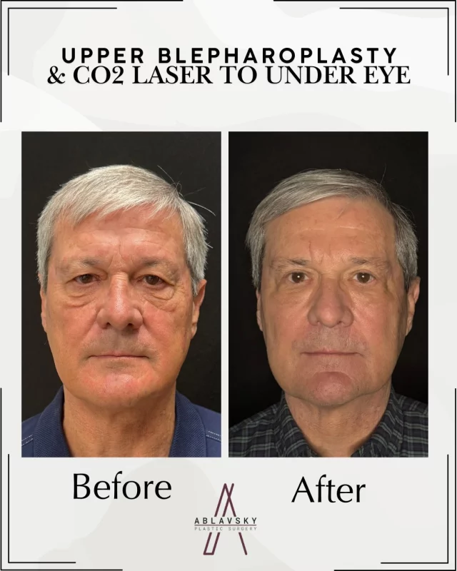 Upper lid refresh + under eye rejuvenation ✨

This transformation combines an upper blepharoplasty with CO2 laser resurfacing to the under eyes—lifting heaviness above while smoothing, tightening, and brightening below. The result? A more rested, youthful look.

Subtle, natural, and confidence-boosting 💫

Thinking about refreshing your eyes? This combo might be your perfect match.

📍19296 Stone Oak Pkwy, Ste 102, San Antonio TX 78258
📞 Schedule your consultation today

#Blepharoplasty #UpperLidLift #CO2Laser #UnderEyeRejuvenation