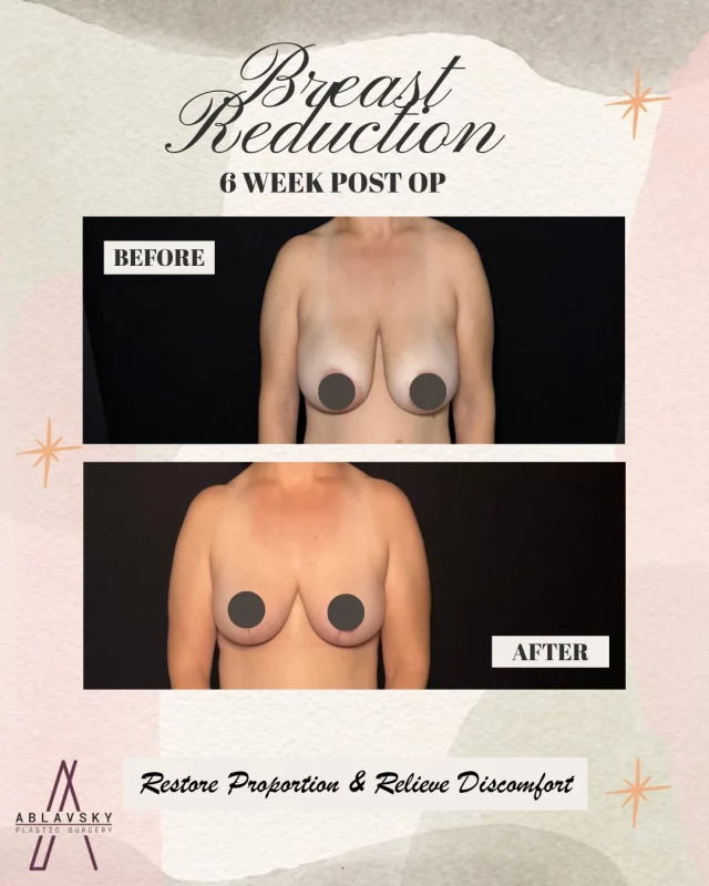✨It’s more than a reduction—it’s a transformation✨

This patient chose a breast reduction to better fit her frame and finally feel comfortable in her body again. From constant back and shoulder discomfort to feeling lighter, more confident, and free in her everyday life—this is what it’s all about.

📲 DM us “REDUCTION” or click the link in bio to schedule your consultation.

📍 19296 Stone Oak Pkwy, Suite 102, San Antonio, TX 78258

#BreastReduction #BreastReductionResults #PlasticSurgeryJourney #ConfidenceBoost